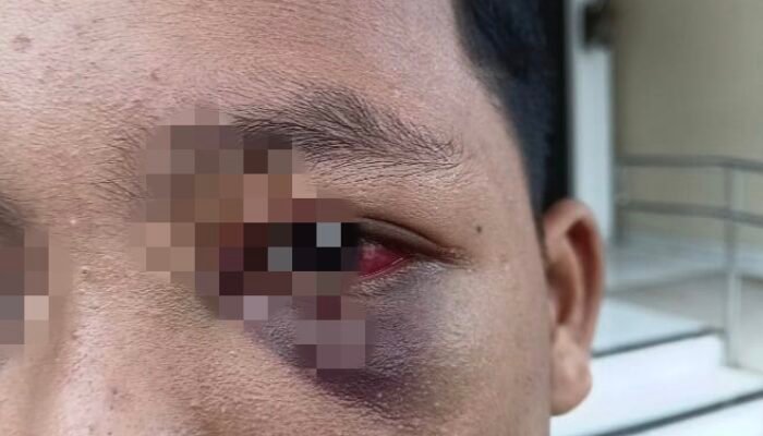 Mata Bengkak hingga Muntah Darah, Siswa Pesantren di Jambi Mengaku Dianiaya Guru